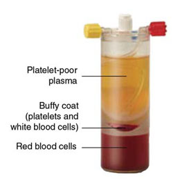 自己血由来　多血小板血漿（Platelet Rich Plasma therapy；PRP）療法